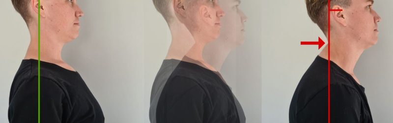 Forward-Head-Posture-1536x1069